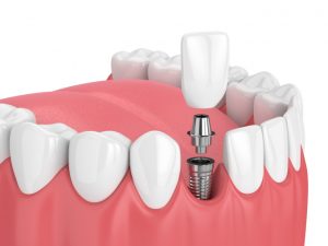 dental implant