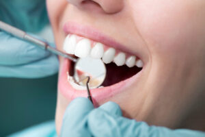 Dental Cleaning by Trusted Dentists Sebring